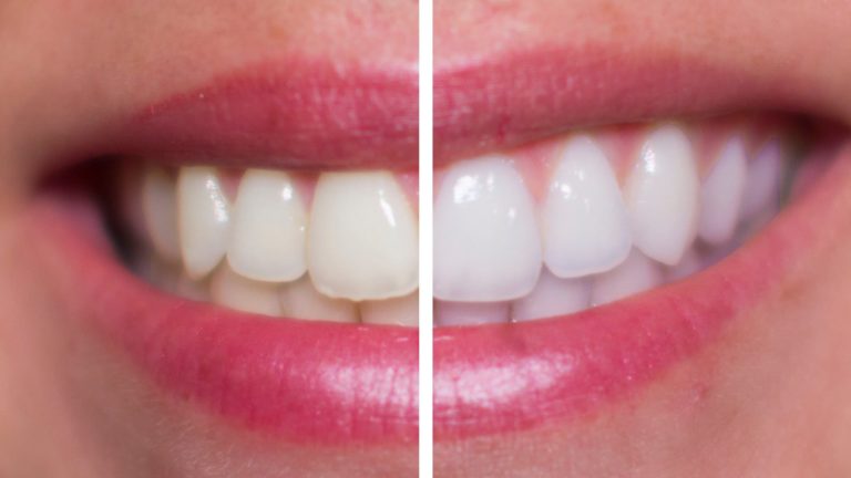 Hydrogen Peroxide Teeth Whitening - ToothStars