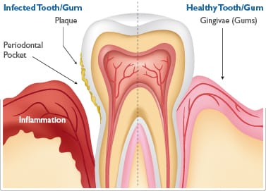 inflamed-gum-periodontal